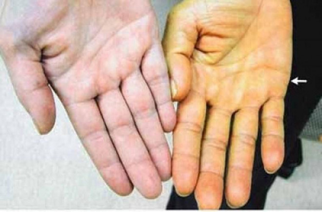 Những dấu hiệu cảnh báo lá gan đang "kêu cứu" - 1