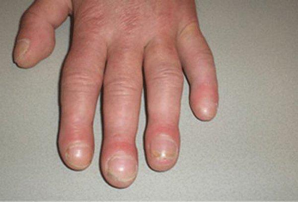Dấu hiệu từ móng tay cảnh báo bệnh, rất có thể cơ thể bạn đang thiếu chất trầm trọng - 2