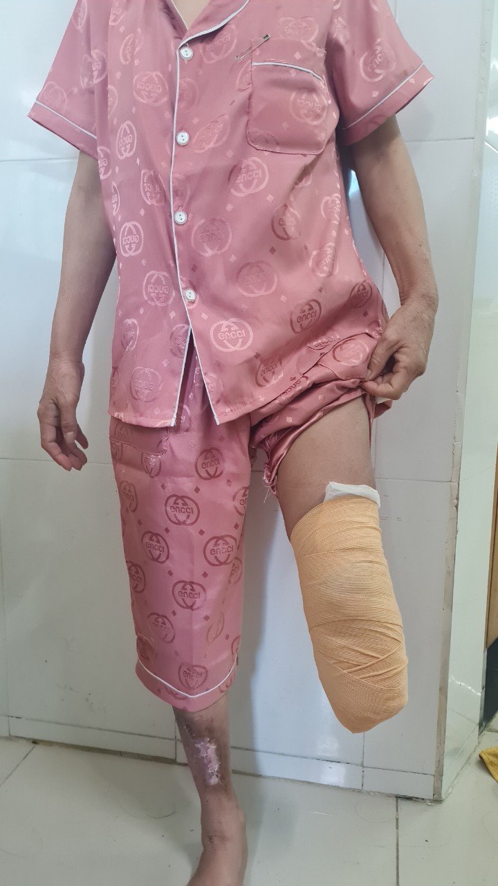 Người phụ nữ 40 tuổi phải cắt cụt chân vì căn bệnh khiến hơn 3 triệu người Việt mắc - 1