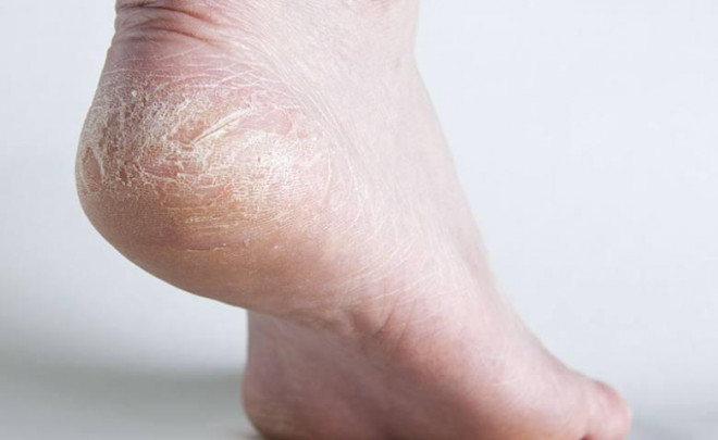 4 sai lầm khiến gót chân bạn luôn khô nứt nẻ, nên điều chỉnh ngay hôm nay - 1