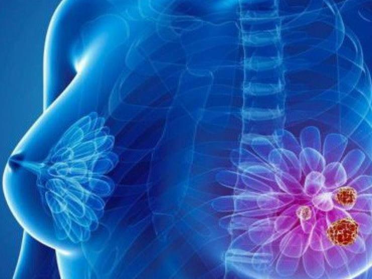 Bác sĩ Bệnh viện K “bật mí” 5 cách để phòng ung thư vú