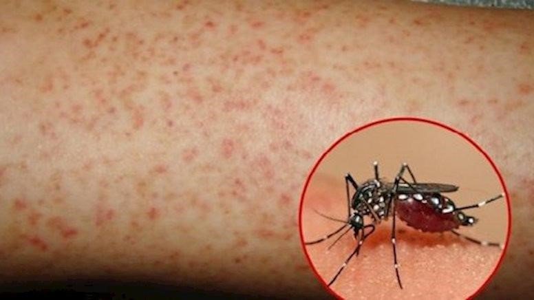 Hà Nội ghi nhận thêm 8 ổ dịch mới, triệu chứng cảnh báo nguy hiểm của sốt xuất huyết - 1