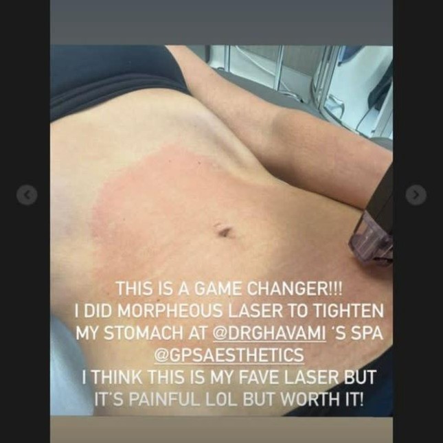 4 phương pháp làm đẹp đau đớn của Kim Kardashian: "Mặt nạ ma cà rồng" gây khiếp sợ - 4