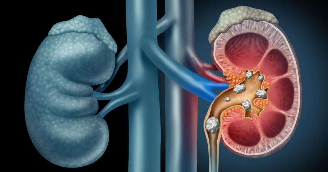 8 lưu ý trong ăn uống để phòng ngừa sỏi thận tái phát - 1