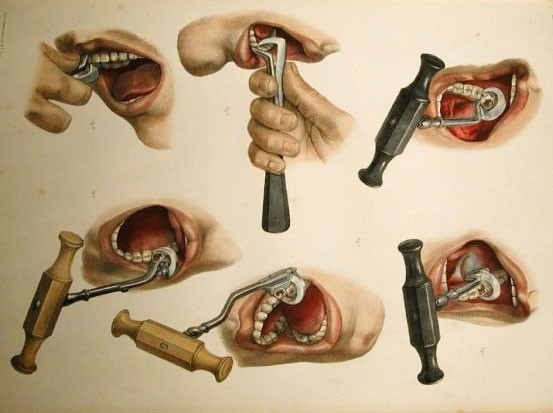Lịch sử nhổ răng: Thời cổ đại như hình thức tra tấn đến sự phát triển của nha khoa hiện đại - 1