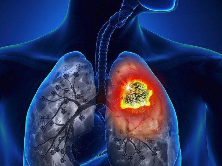 Ung thư phổi liệu có di truyền hay không?