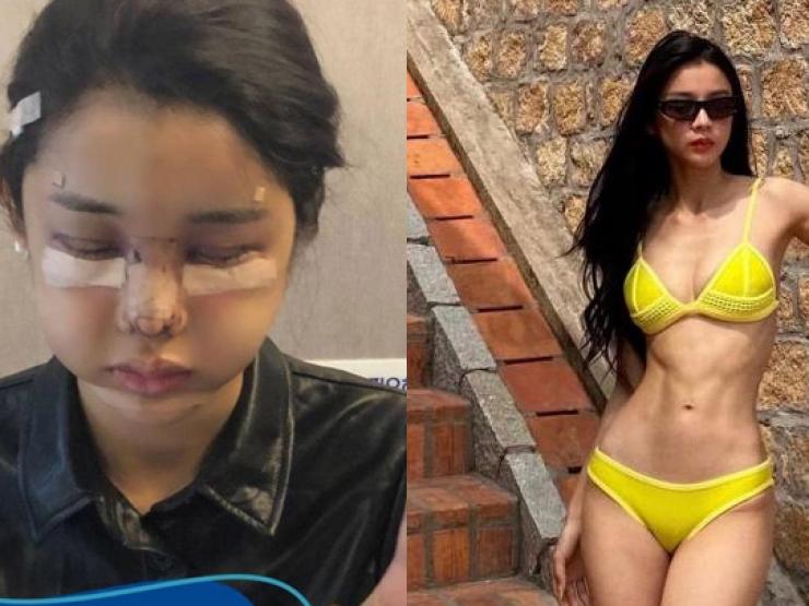 ”Thúy Kiều Tuyên Quang” lộ ảnh phù mặt gây sốc, sự thật là gì?
