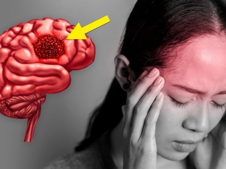 Nhức đầu, buồn nôn có thể là dấu hiệu xuất hiện khối u cực kỳ nguy hiểm