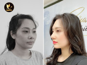 Những ca mũi hỏng, biến chứng nặng được 