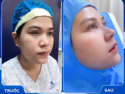 Nâng mũi bọc sụn là gì? Ưu điểm khi sử dụng phương pháp này