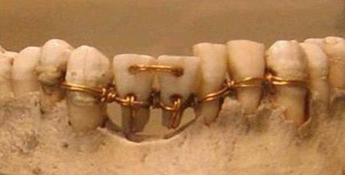 Lịch sử ra đời và phát triển của những chiếc răng giả - 1