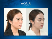 Aqua Clinic ra mắt siêu công nghệ căng bóng da hiện đại