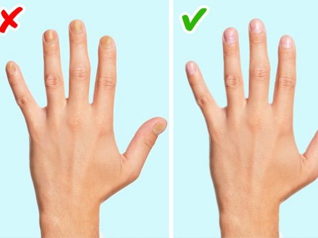 Các dấu hiệu nguy hiểm về bệnh tim mạch có thể nhìn thấy bằng mắt thường