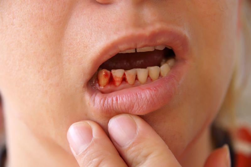 Những trường hợp nào mắc sốt xuất huyết cần nhập viện ngay? - 1