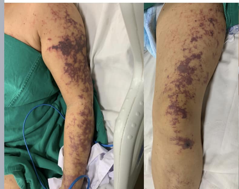 Sau khi ăn lòng lợn, người phụ nữ bị suy hô hấp, nguy kịch - 1
