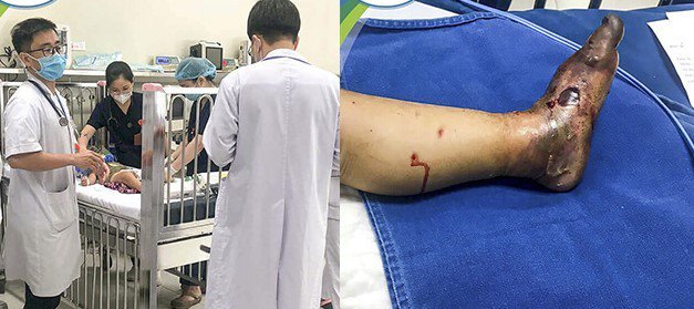Truyền 60 lọ huyết thanh cứu 3 trẻ bị rắn cắn nguy kịch tính mạng - 1