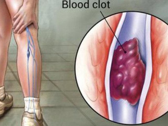 7 dấu hiệu cảnh báo có cục máu đông trong cơ thể, cần làm gì để loại bỏ căn bệnh nguy hiểm này
