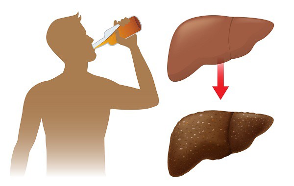 Những loại ung thư nào liên quan đến rượu? - 2