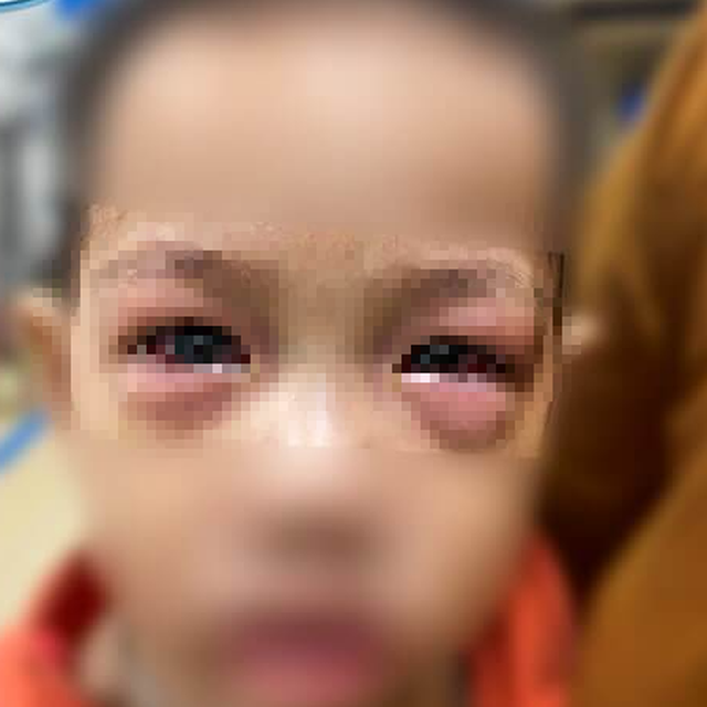 Bác sĩ Bệnh viện Nhi Trung ương khuyến cáo, gần 50 ca đau mắt đỏ trong một tháng, khoảng 20% có biến chứng nặng - 1