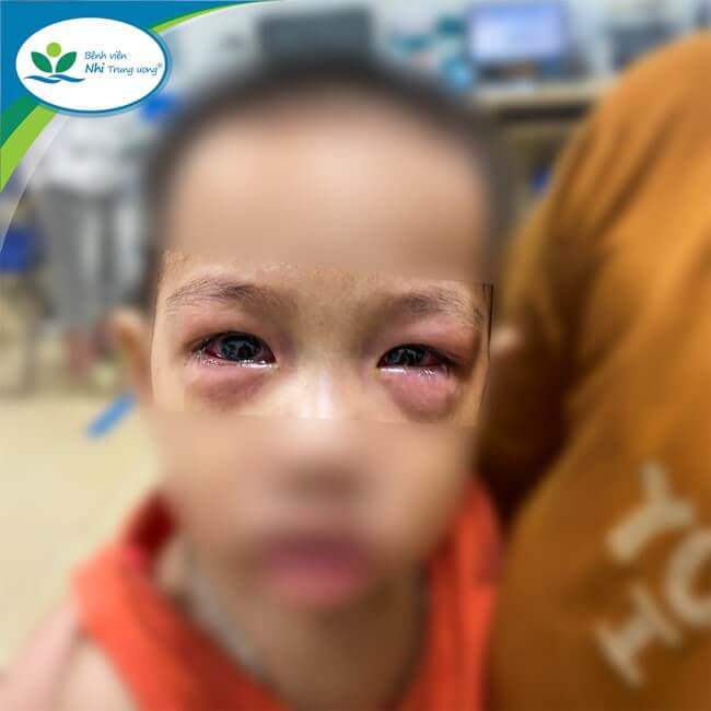 Dịch đau mắt đỏ lây lan nhanh, nhiều người biến chứng nặng - 1