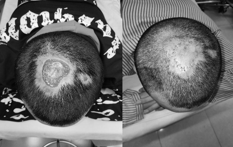 2 bệnh nhân ở Hà Nội bị hoại tử, lở loét da đầu vì tẩy tóc - 1