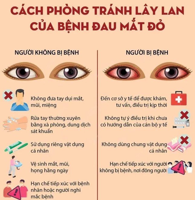 700 trẻ đau mắt đỏ nhập viện trong một tháng - 1