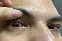 Dịch đau mắt đỏ lây lan nhanh, nhiều người biến chứng nặng