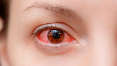 Sau đau mắt đỏ, người bệnh cẩn trọng với tình trạng này - 1