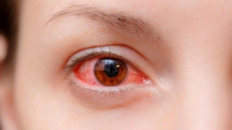 Nhiều gia đình nghỉ học, nghỉ làm vì đau mắt đỏ, Bộ Y tế khuyến cáo 5 biện pháp - 1