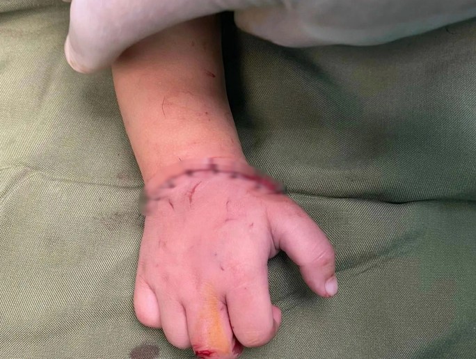 Bé gần 18 tháng tuổi bị máy cắt đá của gia đình cắt đứt lìa bàn tay - 2