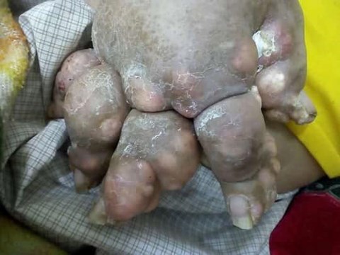 Sốc với bàn chân biến dạng do gout to như chân gấu - 1
