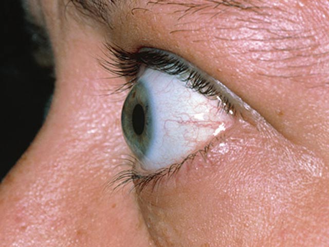 7 dấu hiệu ở mắt tưởng bình thường nhưng cho thấy bạn đang gặp nguy hiểm