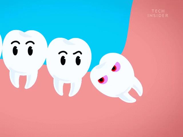 Vì sao răng khôn "hành hạ" con người đến khốn khổ như vậy?