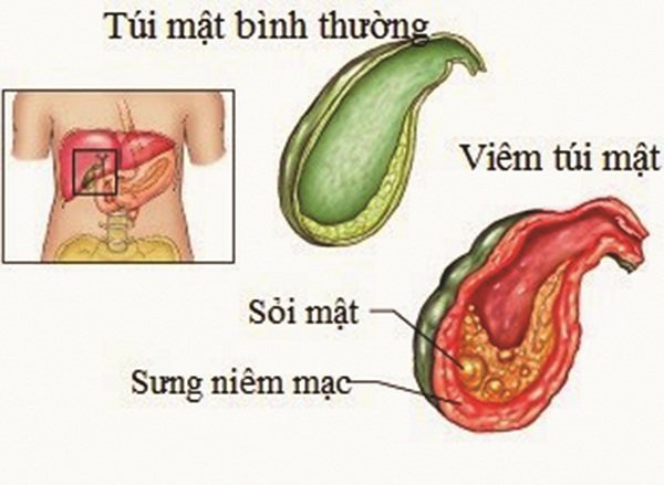 9 tuổi đã bị sỏi mật, nhiều bố mẹ lo tái mặt khi bác sỹ chỉ ra nguyên nhân - 1