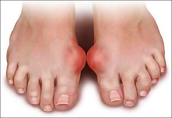 Dấu hiệu từ bàn chân cảnh báo bạn có thể đang mang "trọng bệnh" - 3