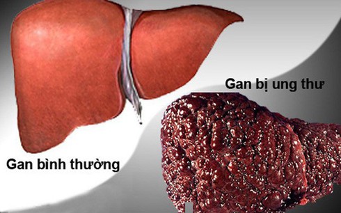 Vượt qua ung thư phổi, ung thư gan trở thành đại dịch - 1