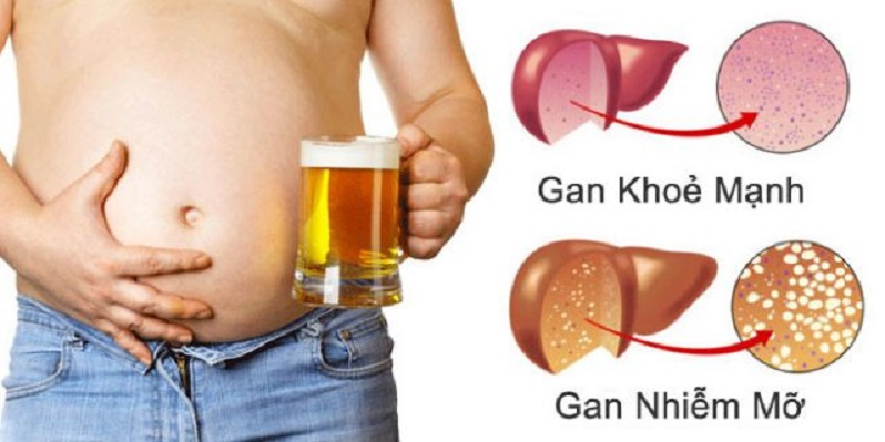 Căn bệnh "sát thủ thầm lặng" gần 30 triệu người Việt mắc dễ biến chứng thành ung thư gan - 1