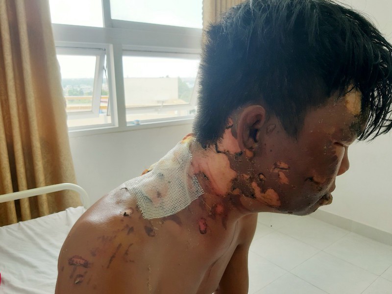 Thanh niên bị chị ruột đổ nước sôi vào đầu - 2