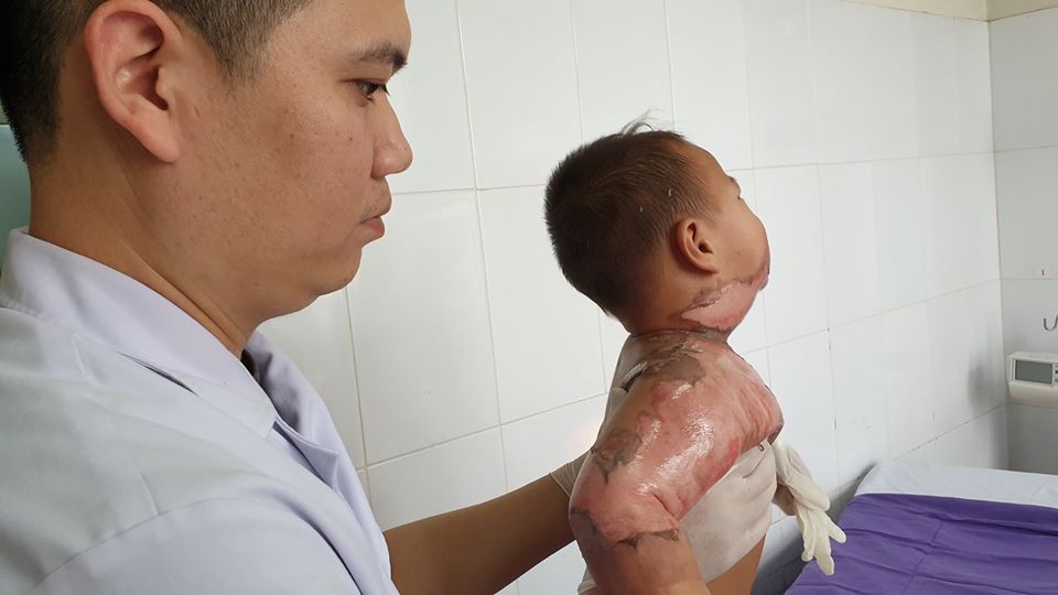 Cả nhà đang ăn lẩu, bé 22 tháng tuổi ngã vào nồi gây bỏng toàn thân - 1