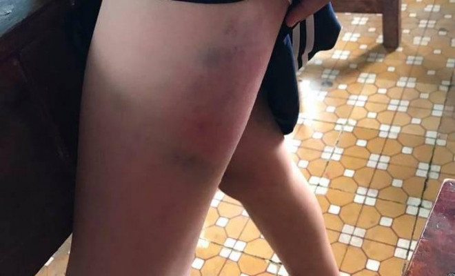 Tạm đình chỉ cô giáo đánh bầm dập bé gái lớp 3 - 2