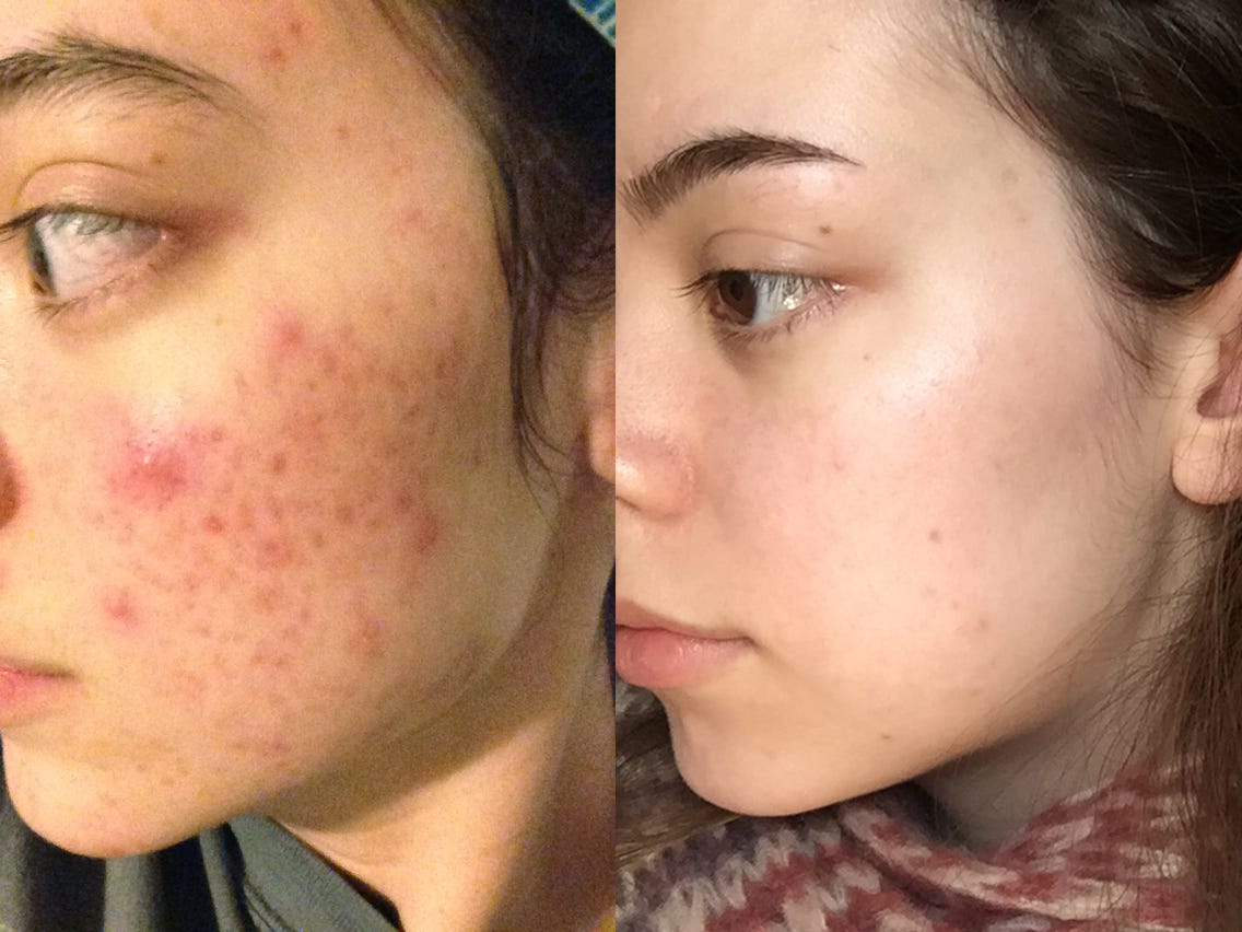 Mụn mủ, mụn viêm: Chuyên gia chỉ mẹo xử lý với chỉ 3 bước đơn giản tại nhà cực rẻ mà hiệu quả - 2