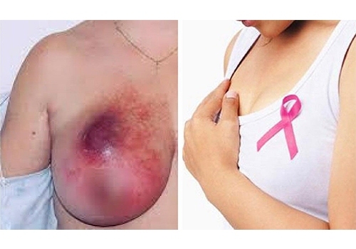 Nhiều phụ nữ trẻ đã mắc ung thư vú, bác sĩ chỉ rõ dấu hiệu nhận biết - 1
