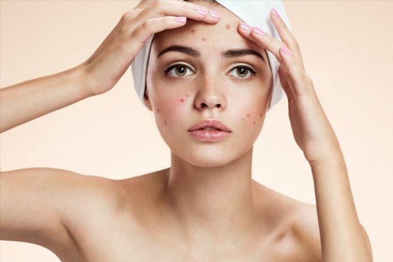 Những gợi ý khi dùng thuốc trị mụn kháng sinh - 3