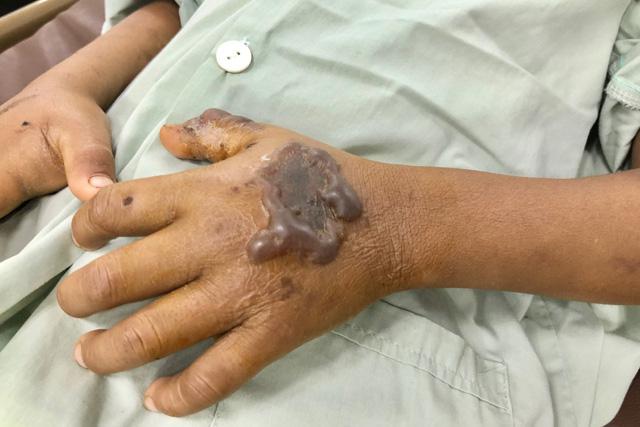 Quảng Ngãi: Rắn lục đuôi đỏ “tái xuất” cắn bị thương nhiều người - 2