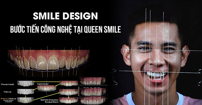 Thiết kế nụ cười – bước tiến công nghệ tại Queen Smile - 1