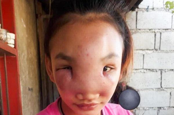 Nặn mụn trên mũi, cô gái 17 tuổi bất ngờ mắc bệnh lạ suốt 1 năm chưa khỏi - 1