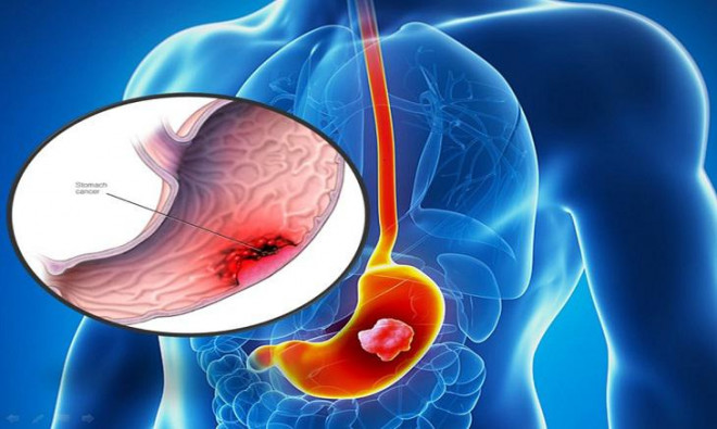 Những thực phẩm là "tội đồ" góp phần phá nát dạ dày của bạn, nếu có dấu hiệu này cần khám ngay để phòng ngừa hậu họa - 1