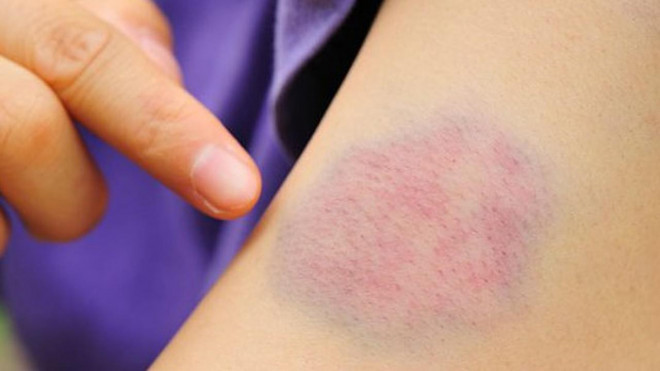 Cẩn trọng với những vết bầm tím trên da, rất có thể bạn đang mắc bệnh cực nguy hiểm - 1