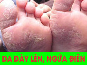 Tuyệt vọng Viêm Da chữa mãi không khỏi, nghe Phó giáo sư mách mẹo này 2-3 hôm đỡ luôn