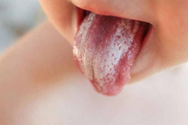 11 dấu hiệu trên lưỡi cảnh báo bệnh - 1